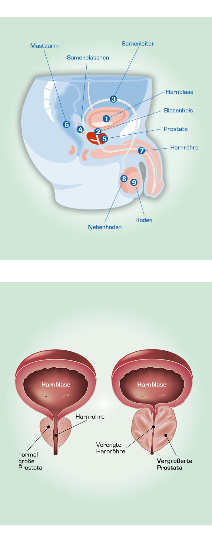 prostata knoten gutartig