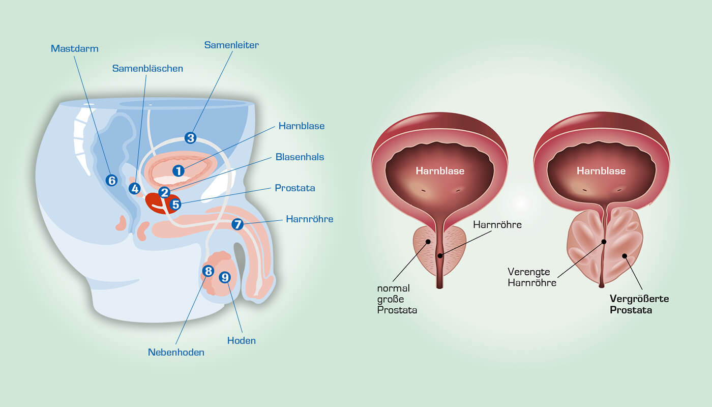 : Eine benigne Prostatahyperplasie ist erkennbar an einer vergrößerten Prostata (Vorsteherdrüse), die, wie hier abgebildet, deutlich größer ist als eine gesunde Prostata. 