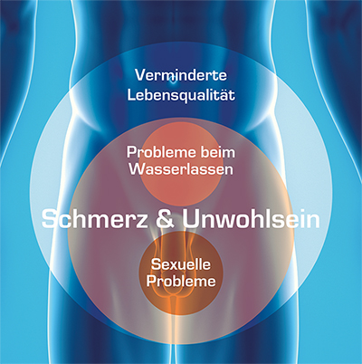 Darstellung der Symptome einer Prostataentzündung